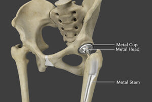 hip replacement img