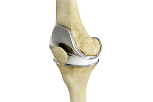total knee replacement img