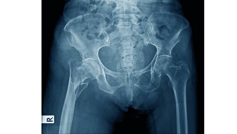 Minimally Invasive Hip Replacement Incisions