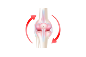 Total Knee Replacement (TKR), also known as total knee arthroplasty, is a surgical procedure designed to alleviate severe knee pain