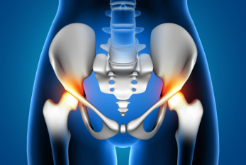 Total hip replacement (THR), also known as total hip arthroplasty, is a surgical procedure designed to alleviate pain, improve function, and enhance the quality of life for individuals