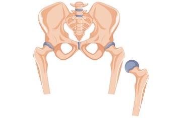 Revision hip replacement, also known as revision total hip arthroplasty, is a specialized surgical procedure performed to replace a previously implanted artificial hip joint that has developed complications, experienced wear and tear, or is no longer functioning effectively. 